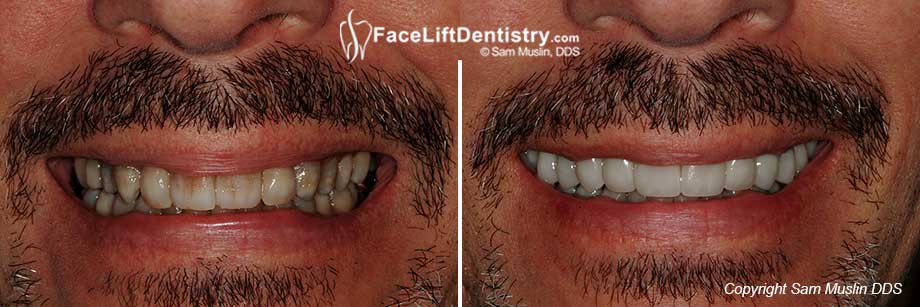 No more tetracycline stains - natural white teeth after treatment.