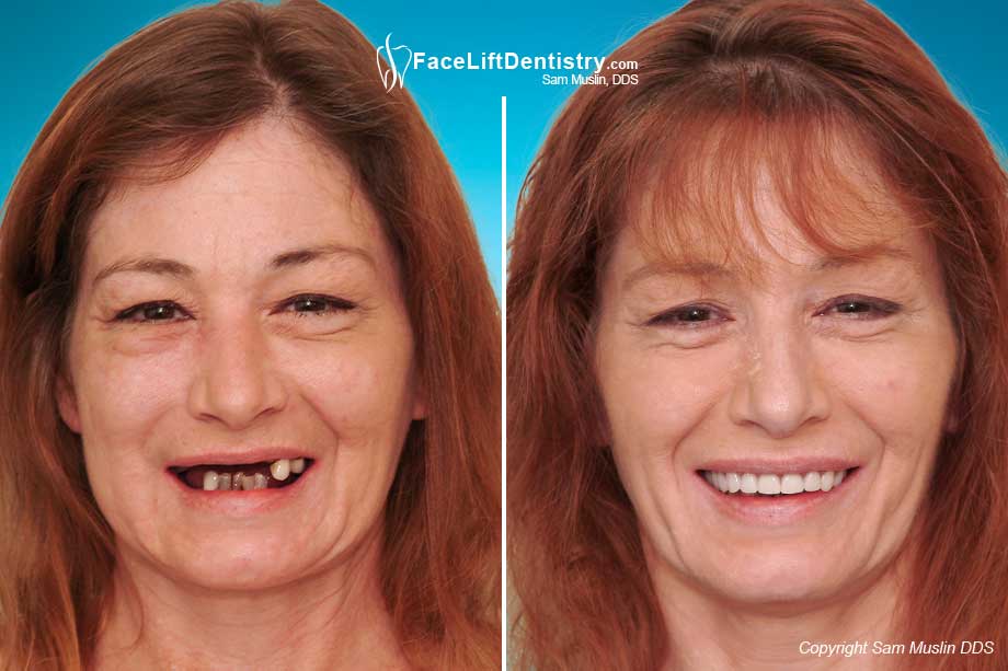 Patient requiring bite correction and full mouth reconstruction - Before and After treatment