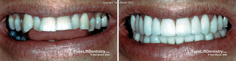 Gap between teeth impaired speech - before and after treatement.