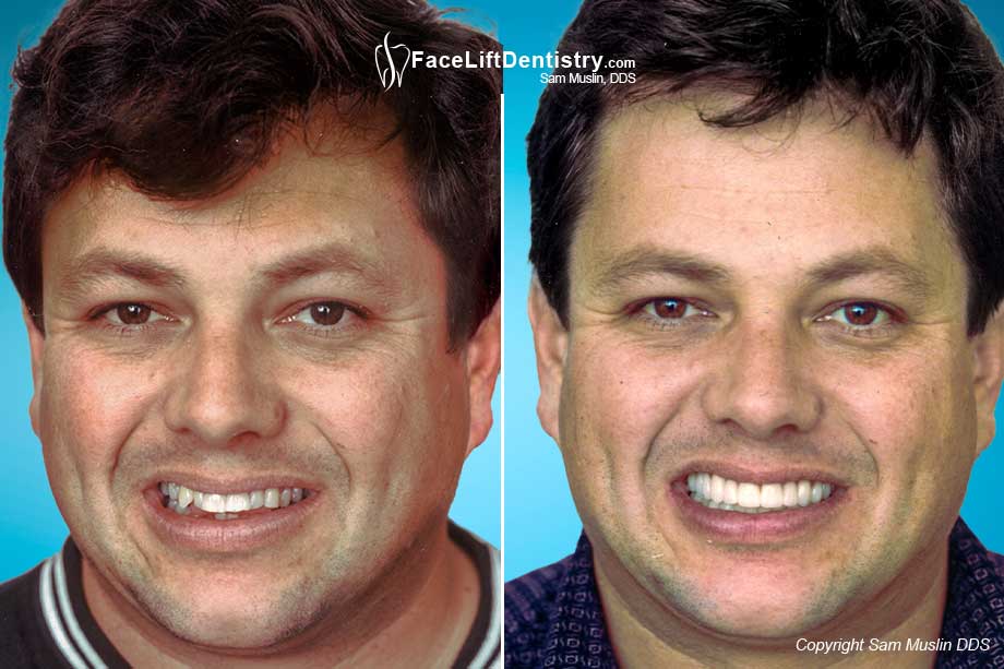 Before and After Photo showing Full Mouth Reconstruction