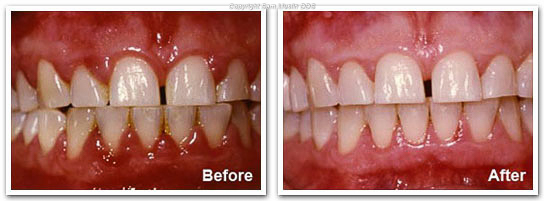  Gingivitis - Before and After Treatment