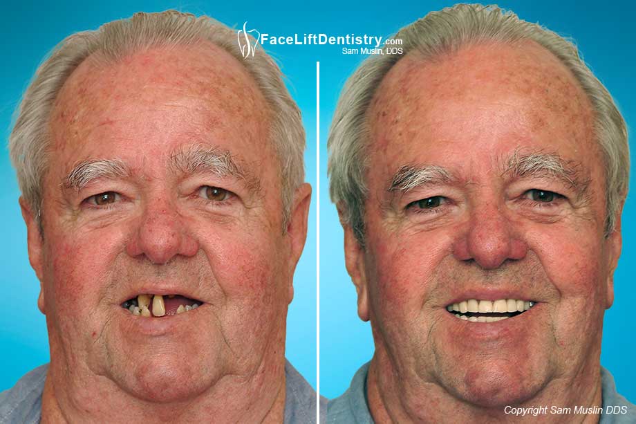 Cosmetic Dentistry Gone Wrong - Before and After