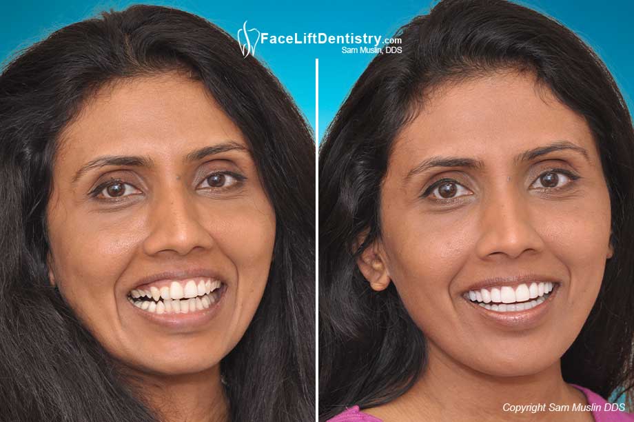 A gummy and a narrow smile corrected and her teeth treated with no-drilling porcelain veneers - before and after treatment
