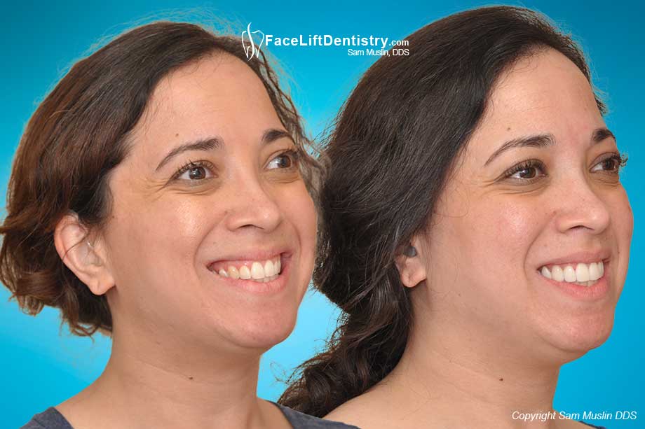 Jaw Position Improved for Speech Clarity - Aesthetic Benefits in Before and After Photo