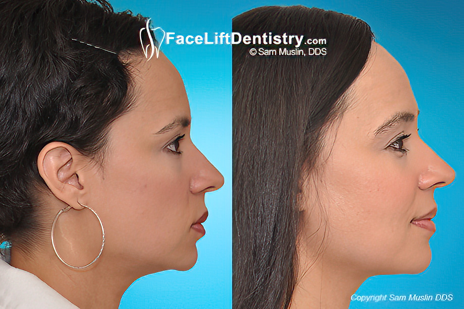 What is a VENLAY® Restoration?