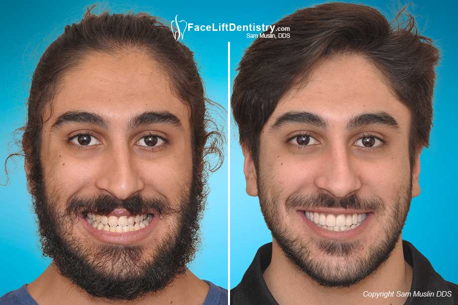 Before and after his bi-lateral crossbite and underbite were fixed without orthognathic jaw surgery 