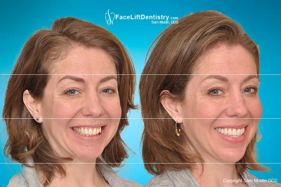 A stressed jaw position in the before photo, and a relaxed ideal jaw position in the after photo, with an enhanced facial profile and aesthetics.