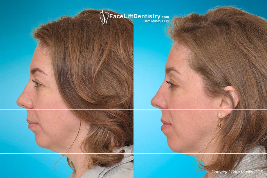 Before photo showing jaw tension. After photo shows a relaxed jaw with the jaw moved into the ideal position