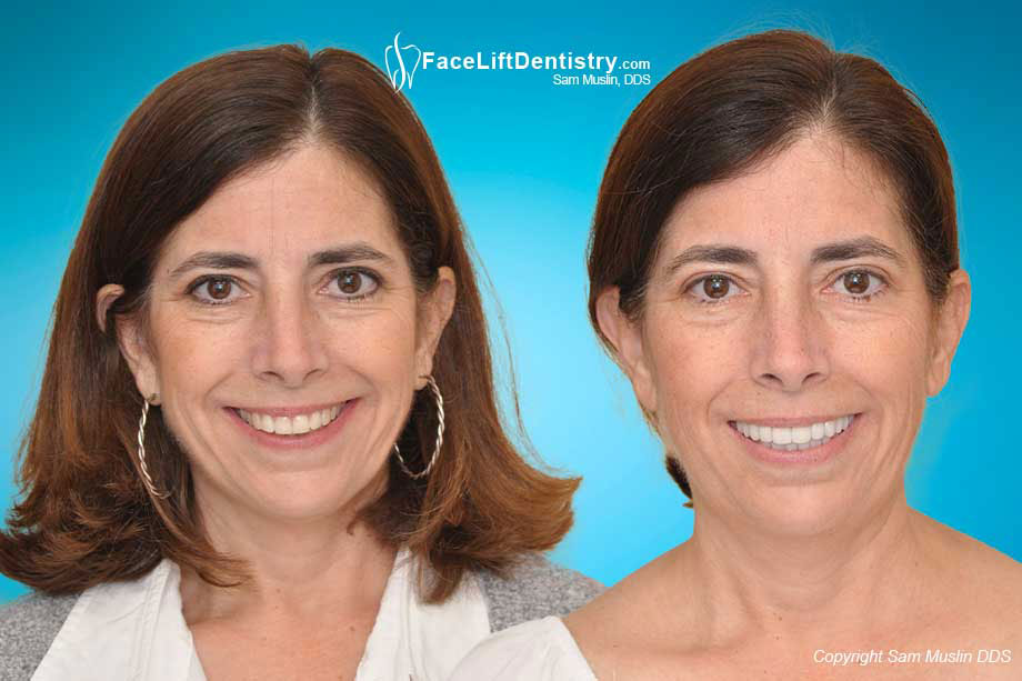 Jaw Tension and Neck Pain Treated without Surgery - Before and After Photo
