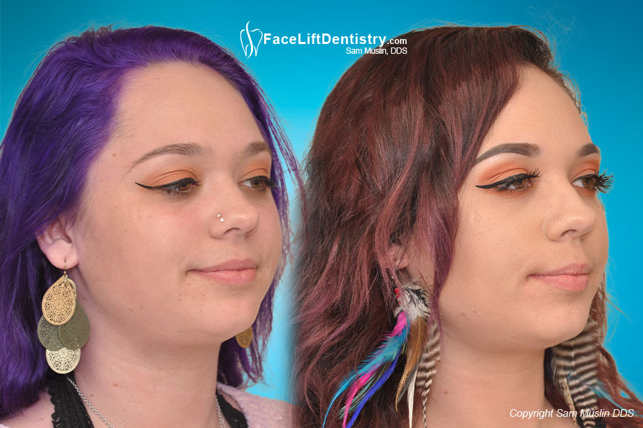 Before and after photo showing jawline enhancement without surgery