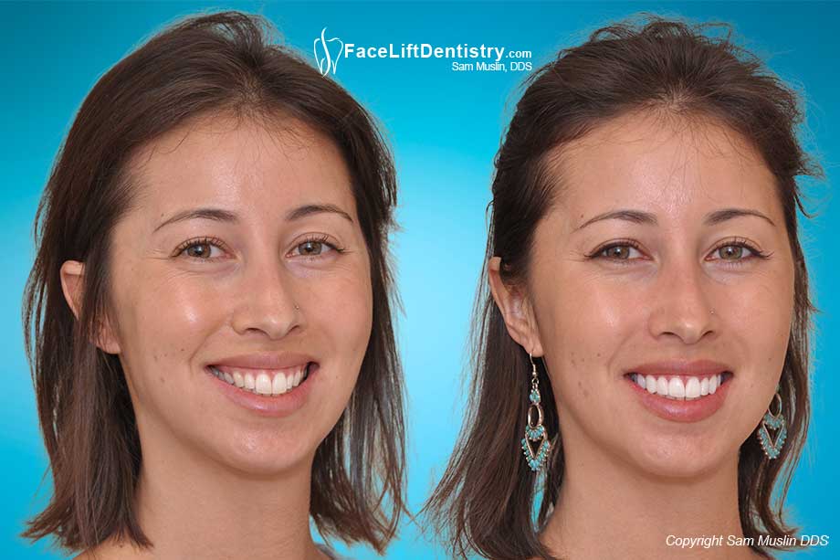 Photo showing how the long front teeth were corrected with non-invasive porcelain veneers.