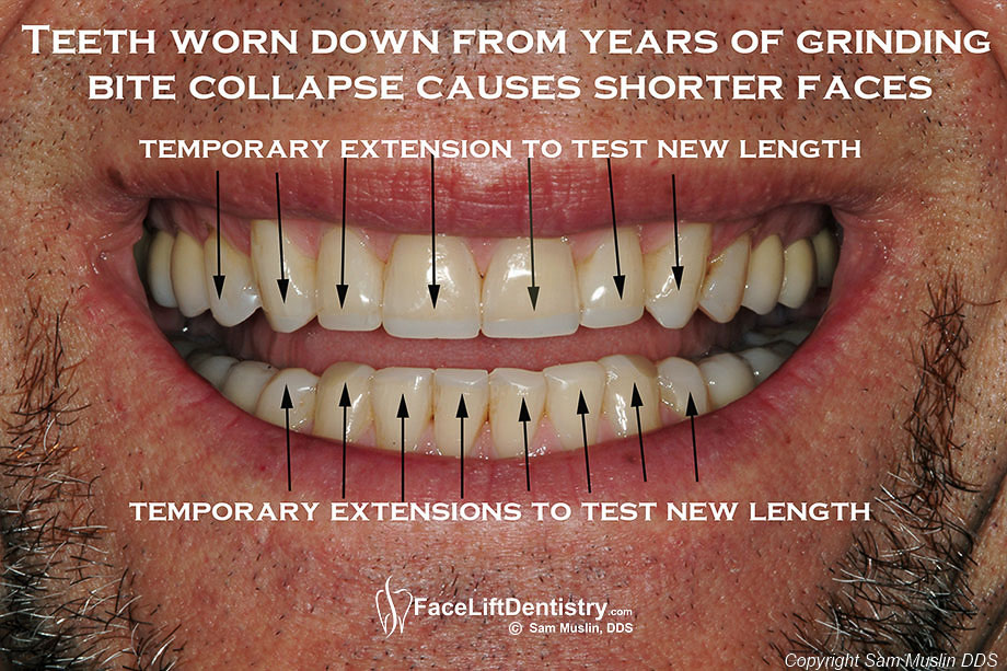  Lengthening short teeth with toothe extensions - before treatment