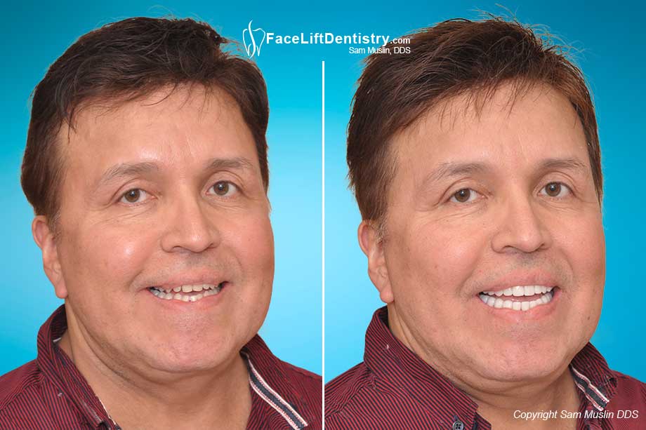 Misalligned jaw complications after jaw surgery, now corrected with VENLAY Restorations