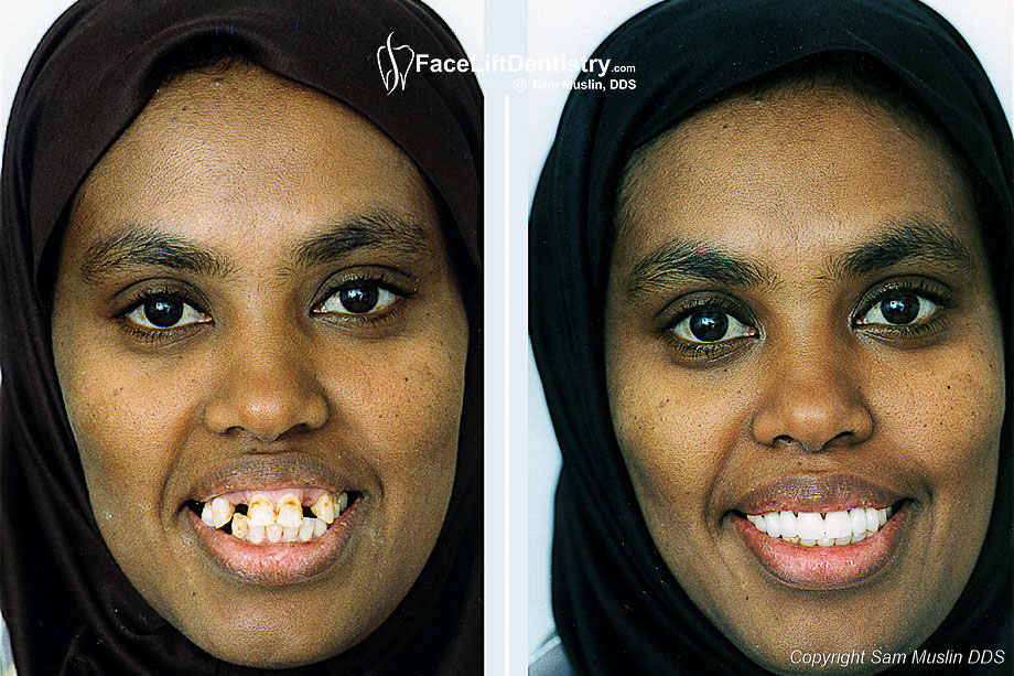  Dental Implants to restore missing or broken teeth - before and after photo