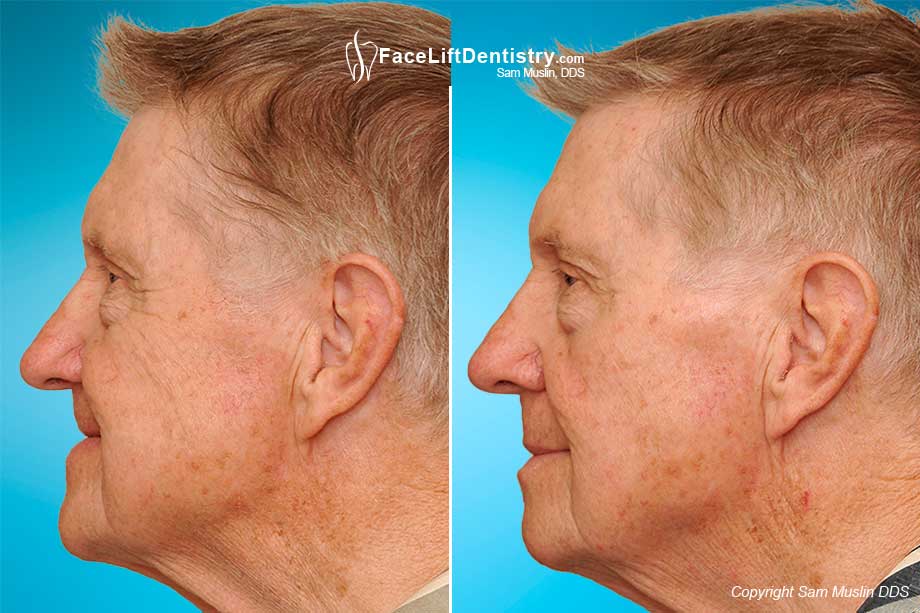 Profile Correction After Full Mouth Reconstreuction