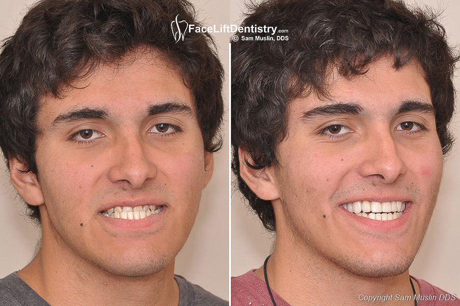 Underbite Surgery Alternative in Two Weeks