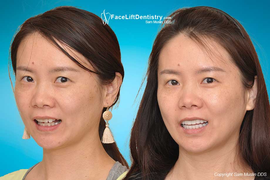 A narrow smile, crooked teeth, and deep overbite corrected - before and after