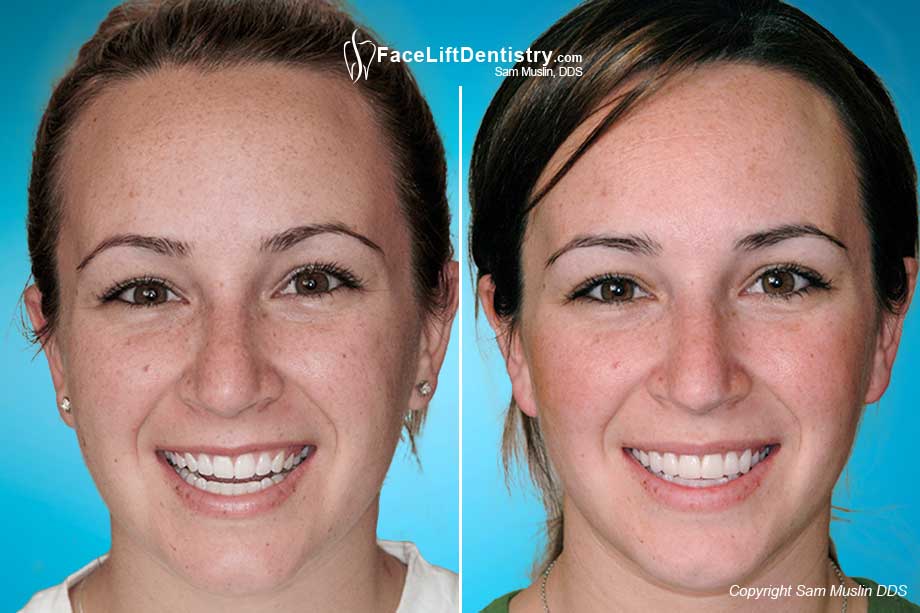  Before and After photo showing no-grinding porcelain veneers.