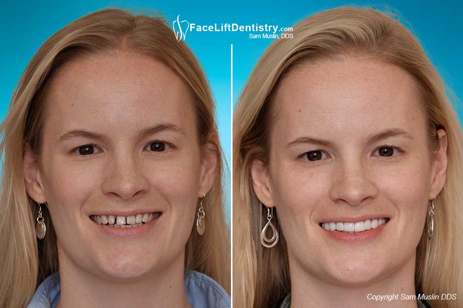  Before and after photo shoing teeth straigtening and gaps eliminated with non invasive porcelain veneers.