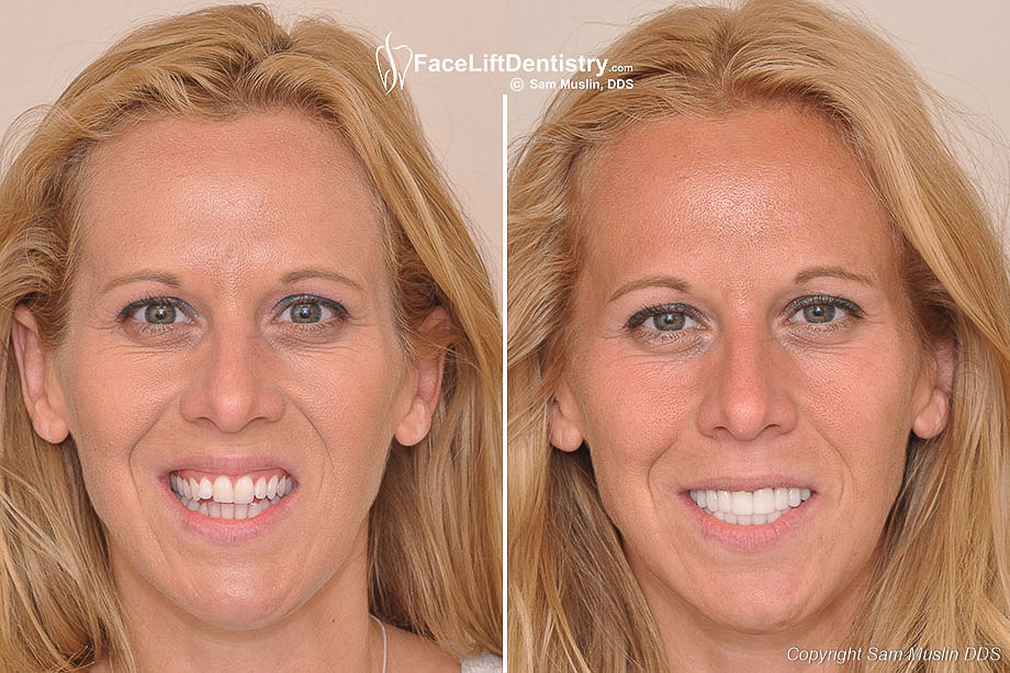 Open Bite Correction with NonSurgical Face Lift Dentistry®
