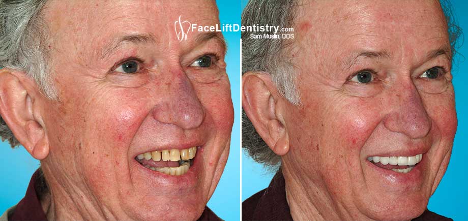 A senior patient smiles before and after non-invasive porcelain veneers were bonded to his teeth.