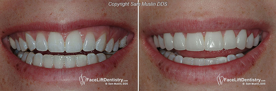  A closeup showing before and after non-invasive porcelain veneers.