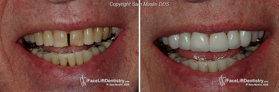  A senior patient's fractured and stained teeth restored with noninvasive porcelain veneers