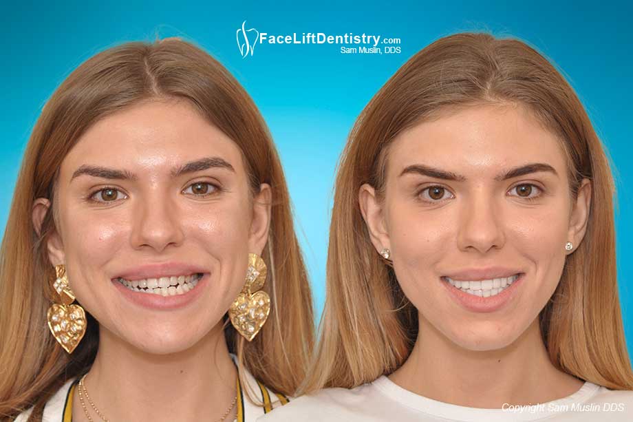 Avoiding Surgery, Braces, Bicuspid Extraction with non-surgical Face Lift Dentistry® Bite Correction - Before and After
