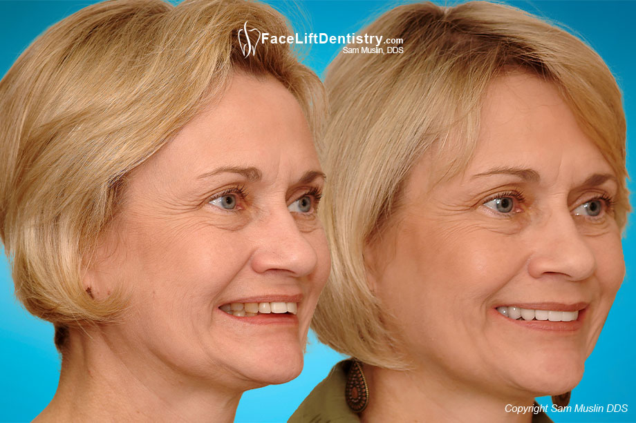 Patient with facial collapse and a deep overbite, before and after non-surgical Face Lift Dentistry® treatment.