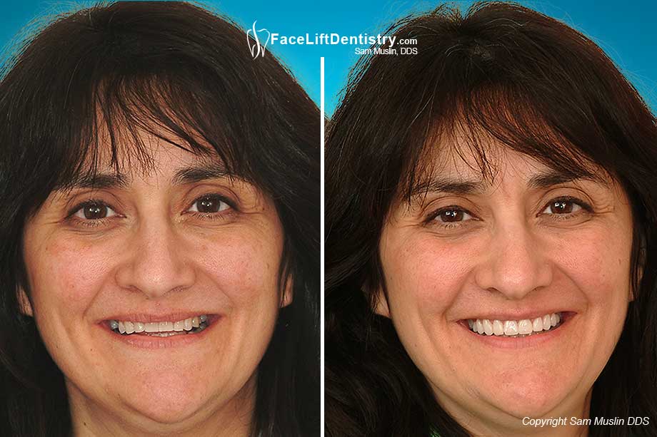  Patient photo with a distinct contrast before and after bite correction.