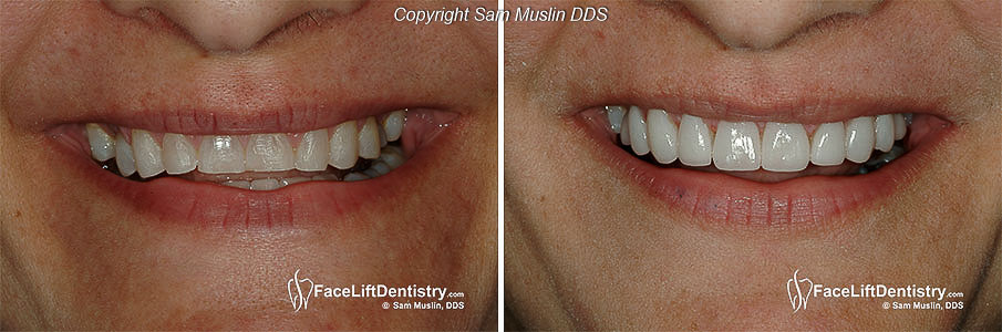  Closeup photo showing the patient's mouth before and after occlusal bite correction