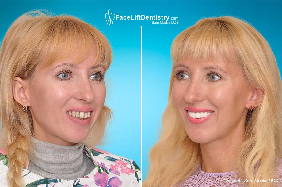 The photo on the right shows her open bite corrected and her teeth straightened - contrasted with the Before Photo on the left.
