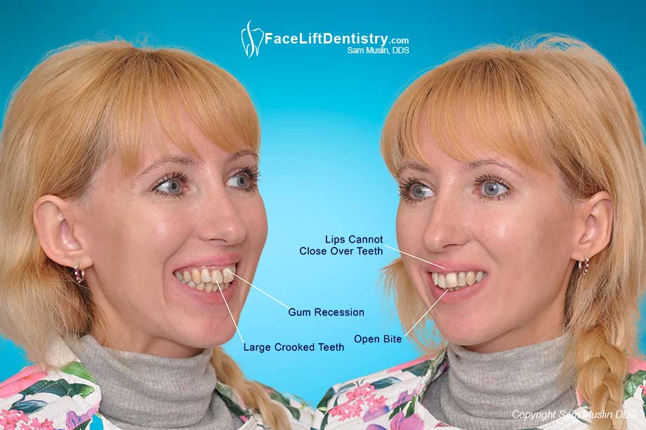  The photo on the left shows gum recession and large crooked teeth. On the right you can see the lips being pushed up and her open bite.