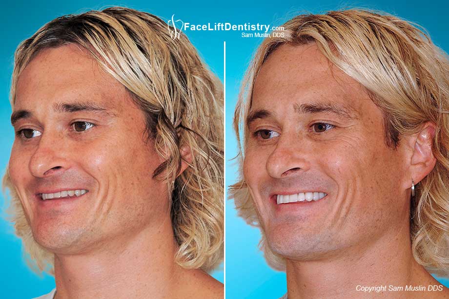 overbite correction bite chin profile surgery without braces correct grinding tooth deep before jaw face veneers short treatment facial faceliftdentistry