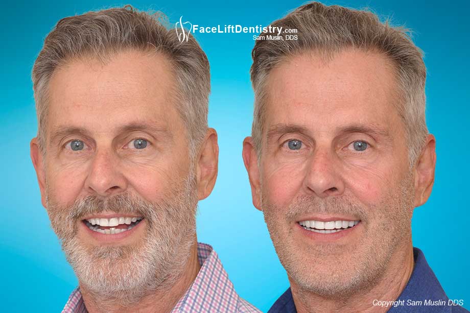 Before and after bicuspid extraction reversal - a patient with a weak chin, hidden by facial hair, and a collapsed bite. 
