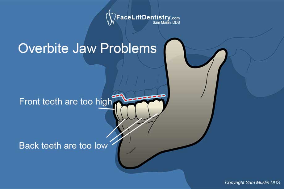 Illustration showing an overbite and resulting jaw tension