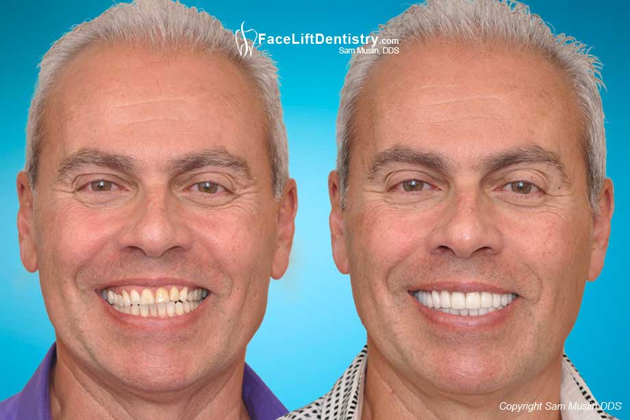 Worn Teeth due to Bruxism, a bad bite and age - Before and After Treatment