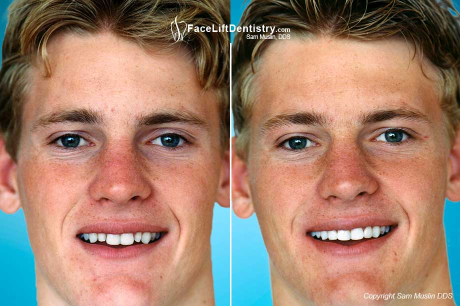 The before photo shows the patient with two small teeth which are way smaller than his other teeth. This was corrected with prepless veneers, visible in the after photo.