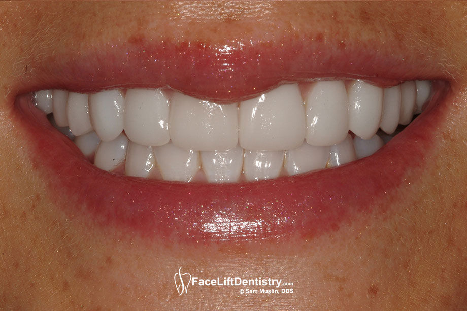 The narrow smile is now corrected and the non-invasive ultra thin veneers are perfectly matched in color and texture to her natural lower teeth.