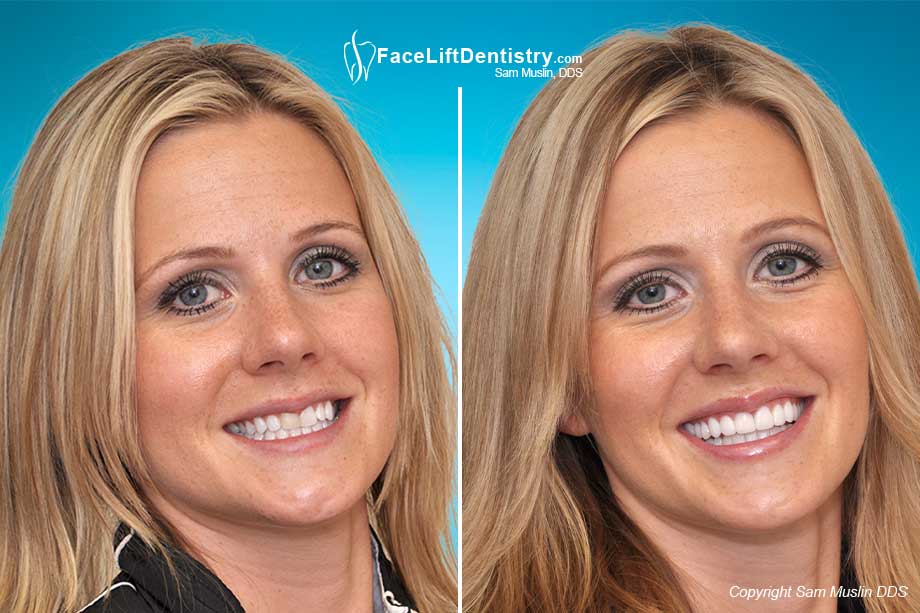 No-drilling ultra-thin porcelain veneer treatment showing a wider smile in the after photo.
