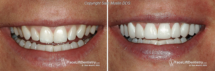  closeup showing the before and after smile of a patient treated with prepless teeth veneers.