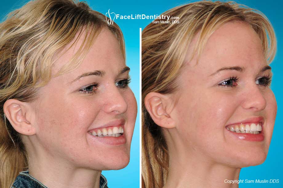 The outcome in this before-after picture shows prepless porcelain veneers.