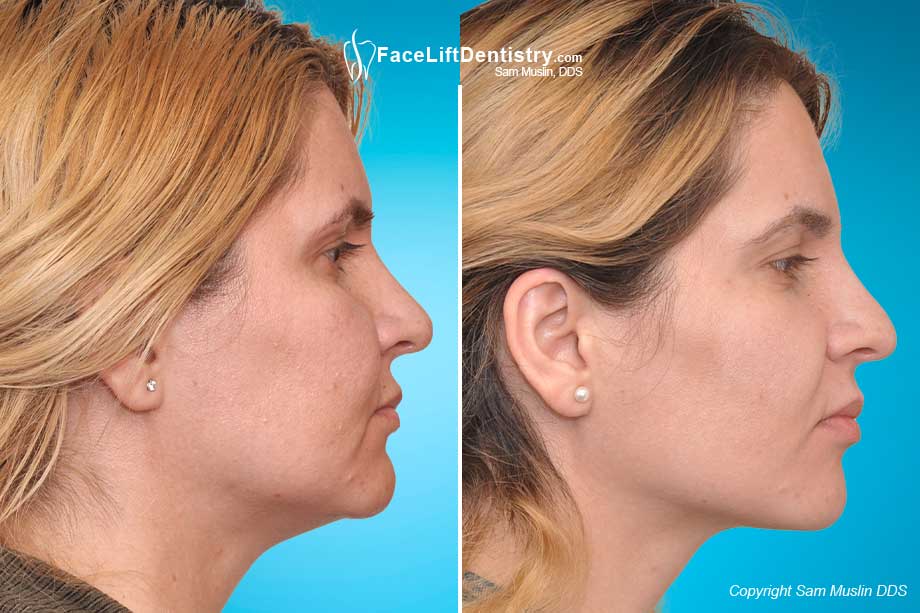 Before and After Face Lift Dentistry, showing a patient with chin size and side profile improvement.