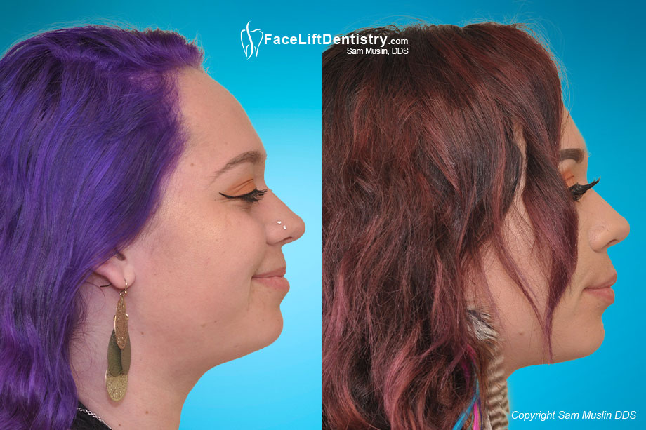 Facial profile enhancement - before and after non-surgical treatment