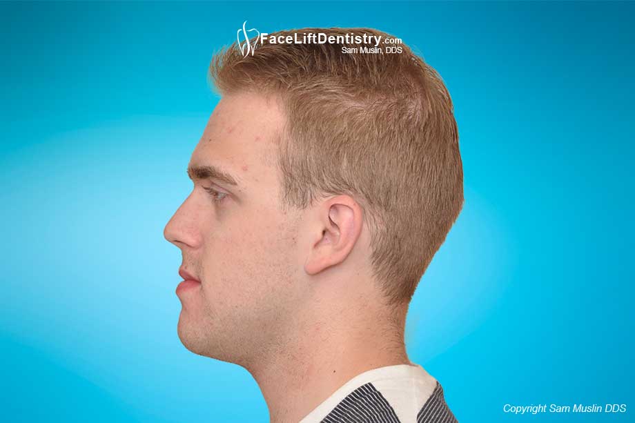 Facial profile after protrusive chin corrected.