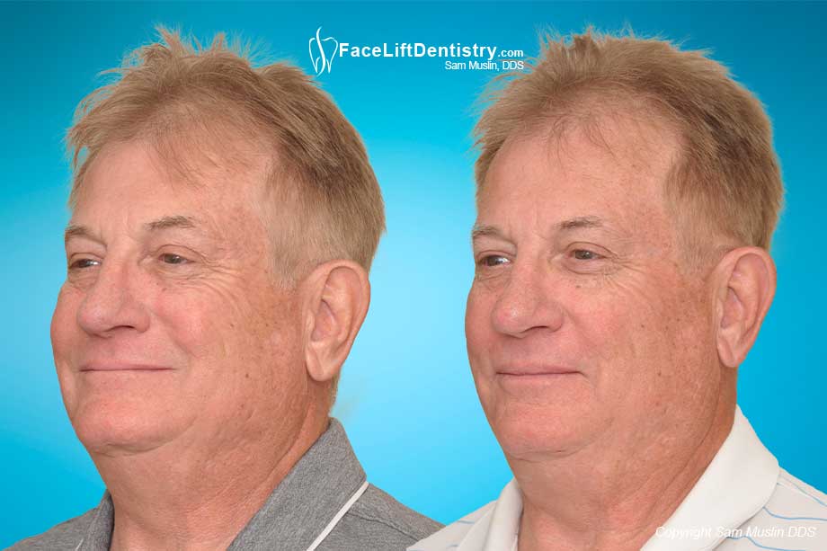 Repairing aging teeth with no-drilling VENLAY Restorations