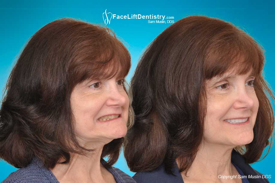 Treating facial collapse with anti-aging Facelift Dentistry®