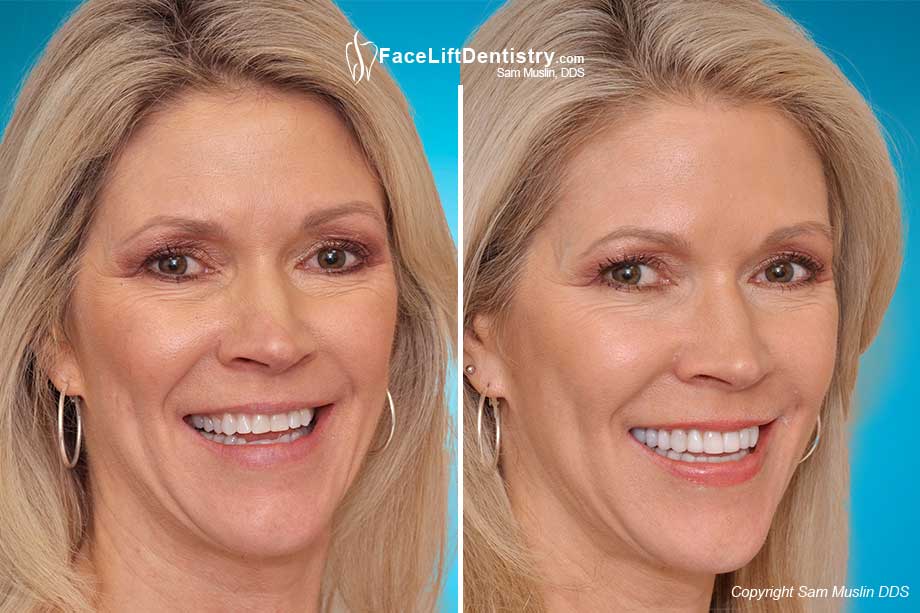 Reversing aging with the Face Lift Dentistry Method - Before and After