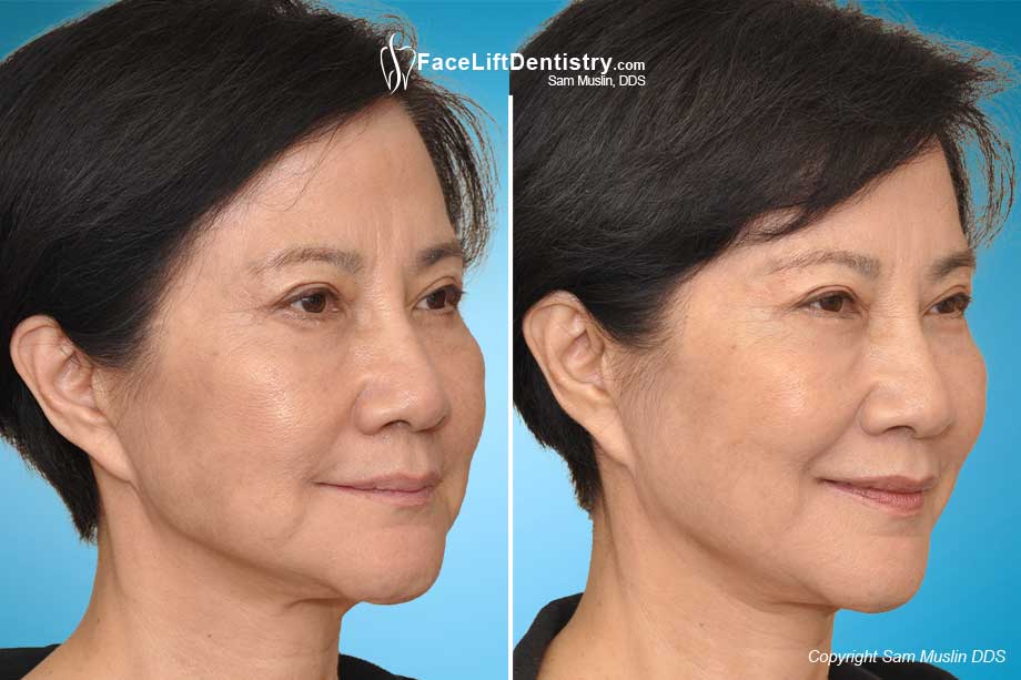 Fixing a collapsed jaw results in smoother facial skin, fuller lips and improved facial shape, made possible with JawTrac®