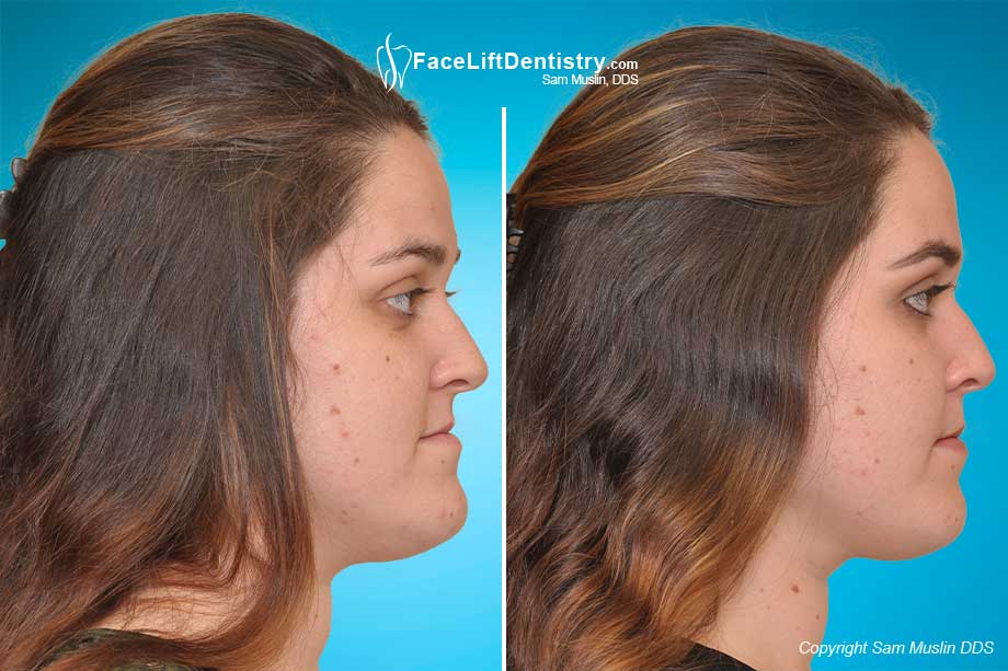 Before and After Skeletal Underbite COrrection showing a repositioned jaw and vastly improved profile.